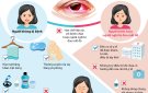 Bài tuyên truyền về phòng chống dịch bệnh đau mắt đỏ